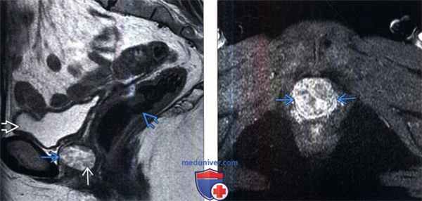 КТ, МРТ, цистоуретрография при дивертикуле уретры