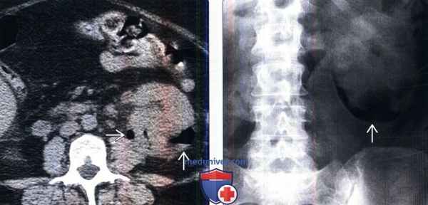 КТ, УЗИ при эмфизематозном пиелонефрите