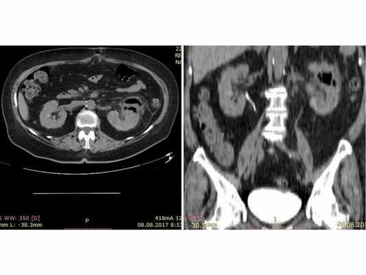 Результат мультиспиральной КТ: видны изменения левой почки, характерные для эмфизематозного пиелонефрита, функция левой почки отсутствует