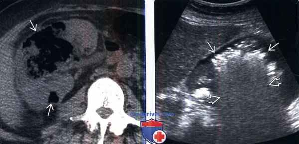 КТ, УЗИ при эмфизематозном пиелонефрите