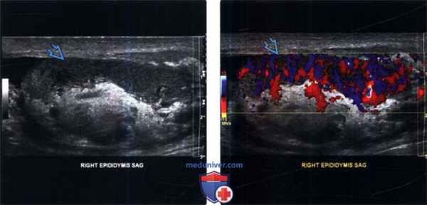 УЗИ при эпидидимите