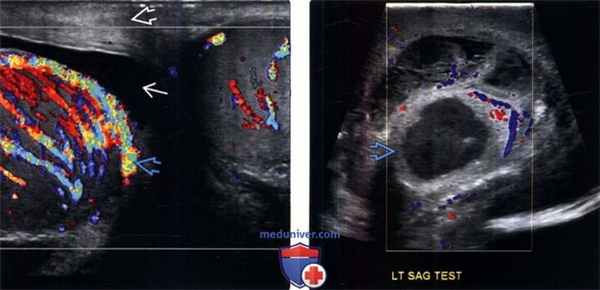 УЗИ при эпидидимите