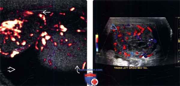 УЗИ при эпидидимите
