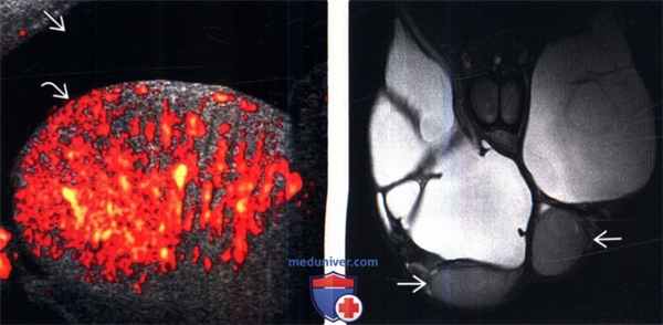 МРТ, УЗИ при гидроцеле
