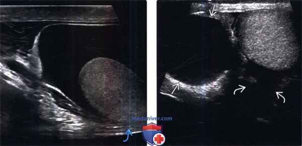 МРТ, УЗИ при гидроцеле