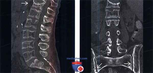 Рентгенограмма, КТ позвоночника при гиперпаратиреозе