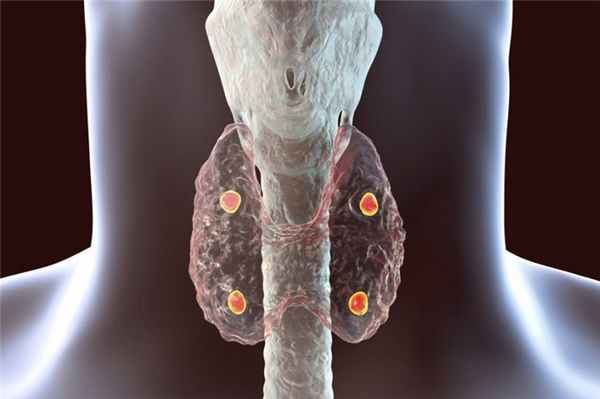 Гиперпаратиреоз