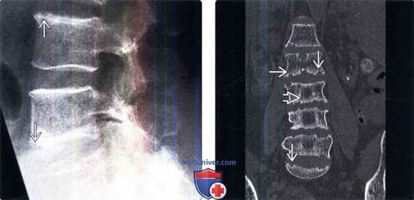 Рентгенограмма, КТ позвоночника при гиперпаратиреозе