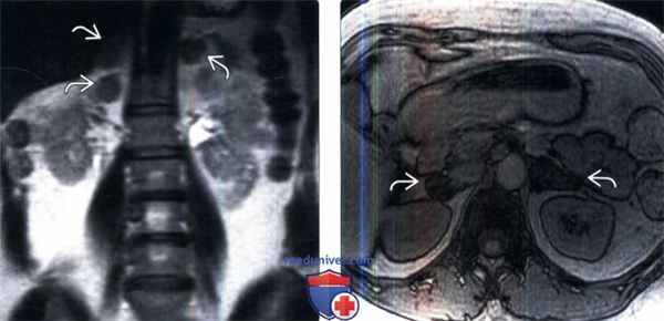 КТ, МРТ, УЗИ при гиперплазии надпочечников