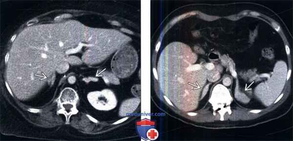 КТ, МРТ, УЗИ при гиперплазии надпочечников