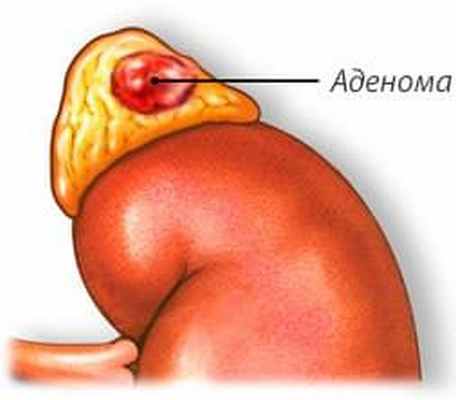 Аденома надпочечника
