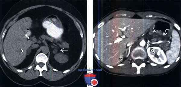 КТ, МРТ, УЗИ при гиперплазии надпочечников