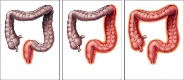 стадии хронического колита
