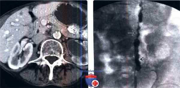 КТ, пиелография при кистозном уретерите