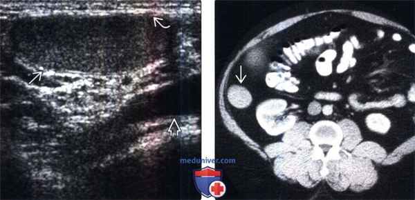 КТ, МРТ, УЗИ при крипторхизме