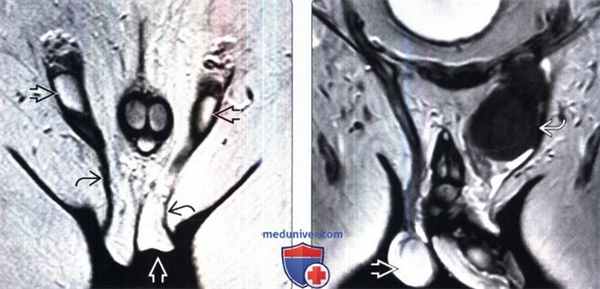 КТ, МРТ, УЗИ при крипторхизме