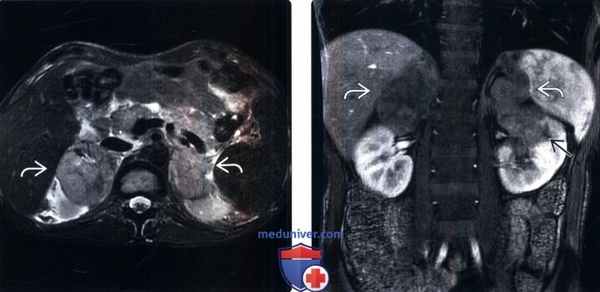 КТ, МРТ, УЗИ при лимфоме надпочечника