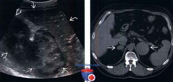 КТ, МРТ, УЗИ при лимфоме надпочечника