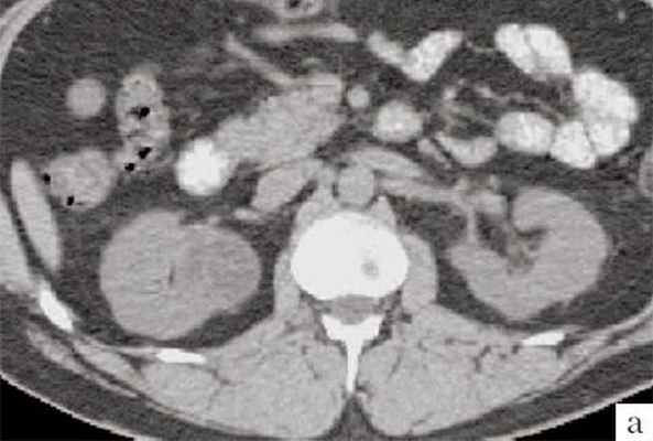 КТ - кистозное образование правой почки, до контрастирования пределяется негомогенное образование неправильной округлой формы с капсулой и едва заметными перегородками, плотность ниже, чем плотность паренхимы почки