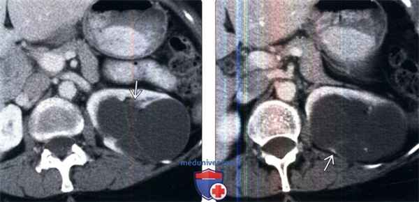 КТ, УЗИ при мультилокулярной кистозной нефроме