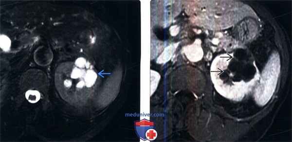 МРТ при мультилокулярной кистозной нефроме
