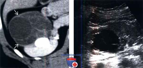 КТ, УЗИ при мультилокулярной кистозной нефроме