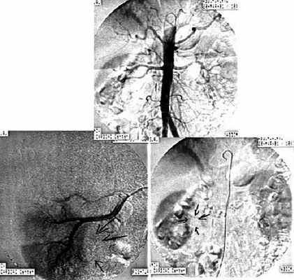 Ангиограммы кистозной нефромы почки - в нижнем полюсе правой почки определяется аваскулярное образование шаровидной формы, не накапливающее контрастное вещество, до 30 мм в диаметре (стрелки)