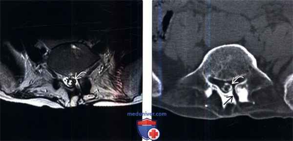 МРТ при оссифицирующем арахноидите