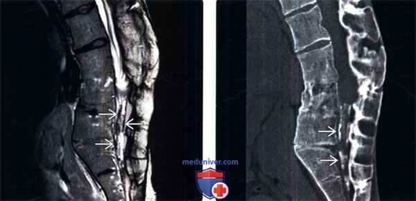 МРТ при оссифицирующем арахноидите