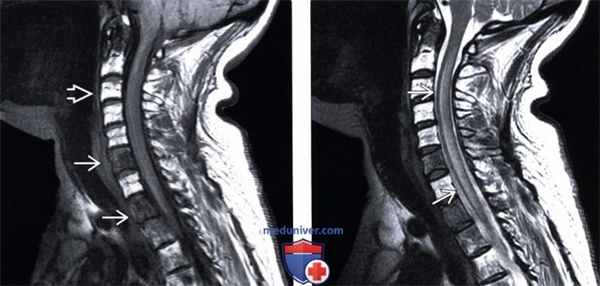 МРТ при паранеопластической миелопатии