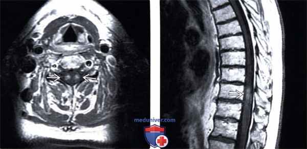 МРТ при паранеопластической миелопатии