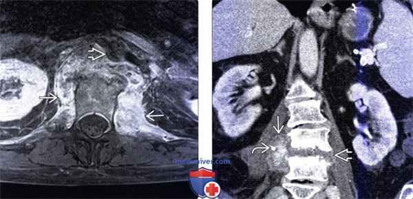 КТ, МРТ при паравертебральном абсцессе