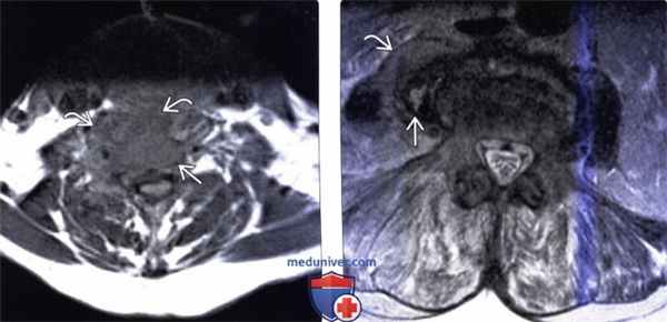КТ, МРТ при паравертебральном абсцессе