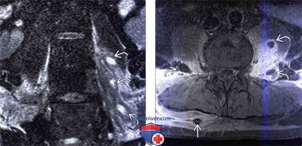 КТ, МРТ при паравертебральном абсцессе