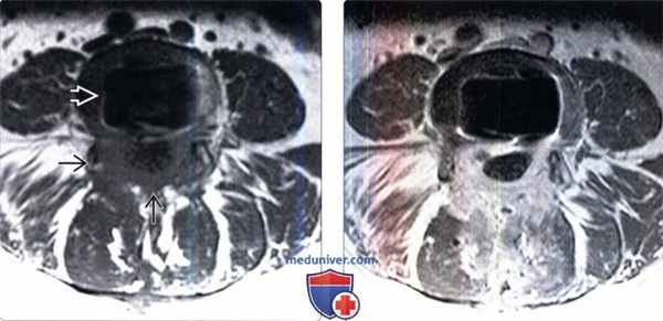 МРТ при перидуральном фиброзе