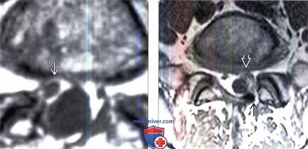 МРТ при перидуральном фиброзе