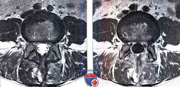 МРТ при перидуральном фиброзе