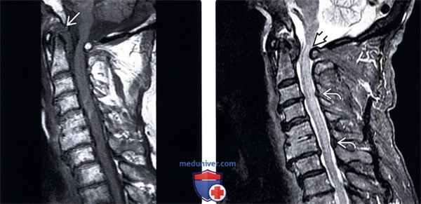 КТ, МРТ перизубовидной псевдоопухоли