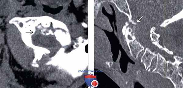 КТ, МРТ перизубовидной псевдоопухоли