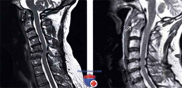 КТ, МРТ перизубовидной псевдоопухоли
