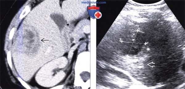 Лучевая диагностика гнойного абсцесса печени