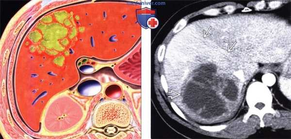 Лучевая диагностика гнойного абсцесса печени