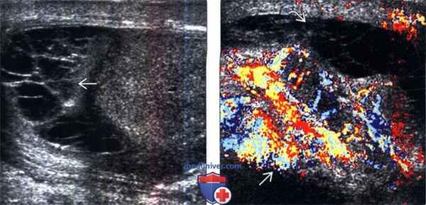 УЗИ при пиоцеле