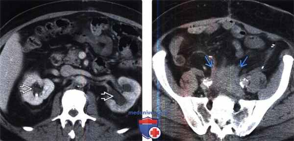 Рентгенограмма, КТ при ретроперитонеальном фиброзе