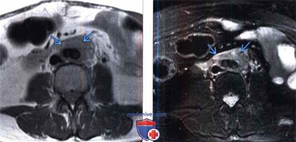 Рентгенограмма, КТ при ретроперитонеальном фиброзе