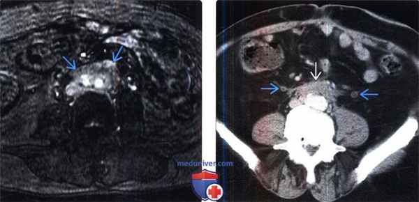 Рентгенограмма, КТ при ретроперитонеальном фиброзе