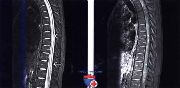 МРТ при сифилитическом миелите