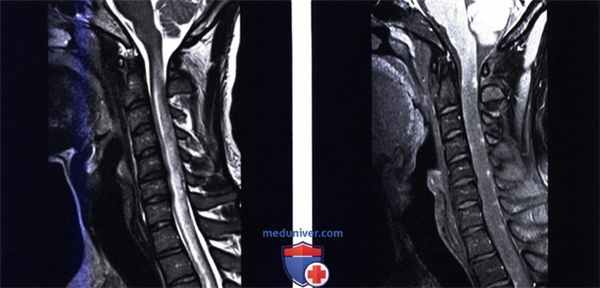 МРТ при сифилитическом миелите