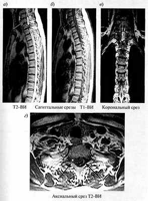 Постравматическая сирингомиелия