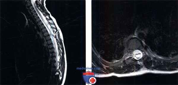 МРТ при сирингомиелии